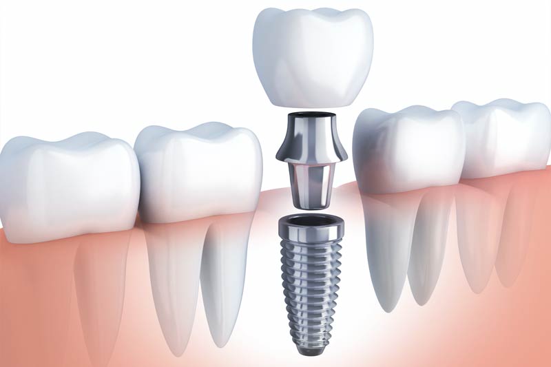 Implants Dentist in Fresno